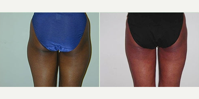 Liposuction before and after photo