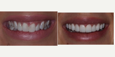 Porcelain Veneers before and after photo