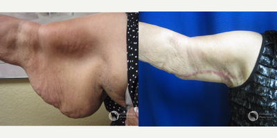 Arm Lift before and after photo