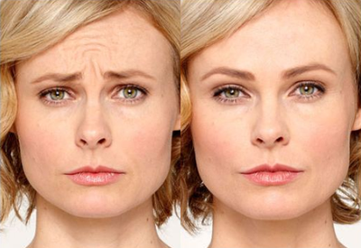 Botox before and after photo