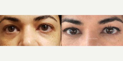 Belotero before and after photo