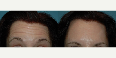 Botox before and after photo