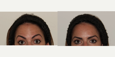 Botox before and after photo