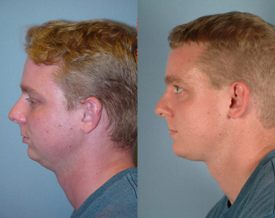 Chin Implant before and after photo
