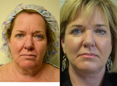 Eyelid Surgery before and after photo