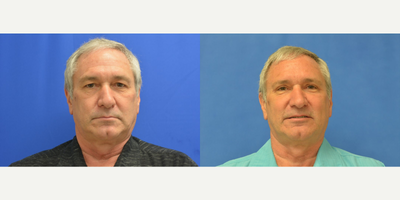 Eyelid Surgery before and after photo