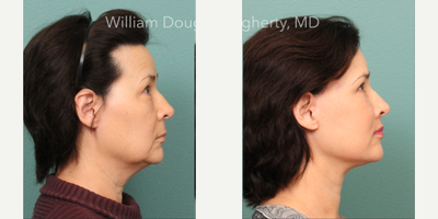 Facelift before and after photo