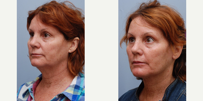 Mini Facelift before and after photo