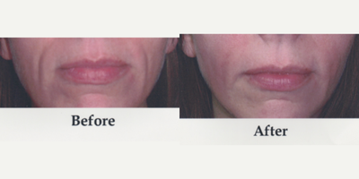 Restylane before and after photo