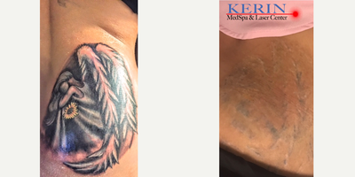 Tattoo Removal before and after photo