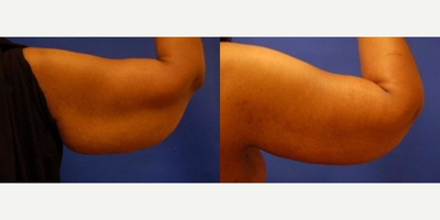 Arm Lift before and after photo