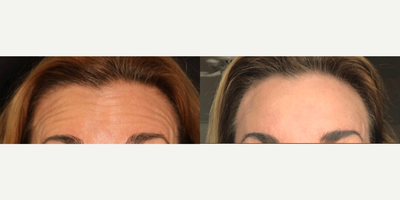 Botox before and after photo