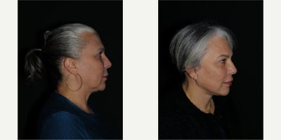 before and after image