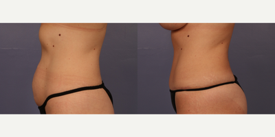 Liposuction before and after photo