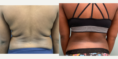 Mini Tummy Tuck before and after photo