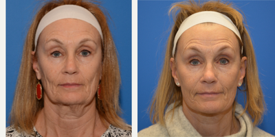 Neck Lift before and after photo