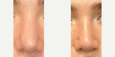 Rhinoplasty before and after photo