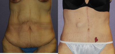 Tummy Tuck before and after photo
