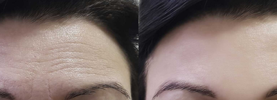Botox before and after photo