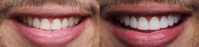 Dental Bonding before and after photo