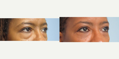 Eyelid Surgery before and after photo