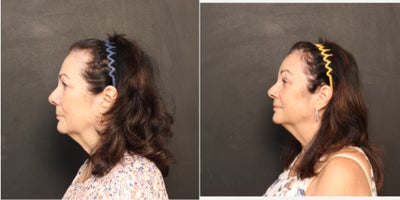 Eyelid Surgery before and after photo