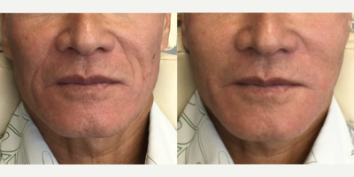 Sculptra before and after photo