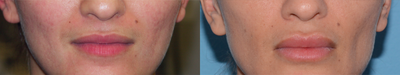 Volbella before and after photo
