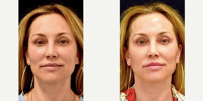 Dermal Fillers before and after photo