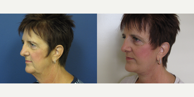 Facelift before and after photo