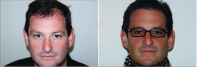 Hair Loss Treatment before and after photo