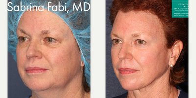 Laser Resurfacing before and after photo