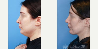 Neck Lift before and after photo