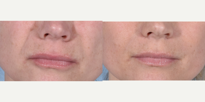Restylane Refyne before and after photo