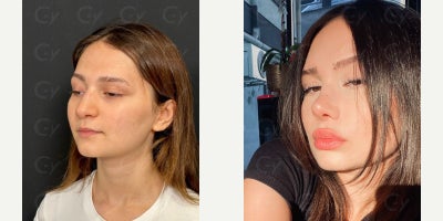Rhinoplasty before and after photo