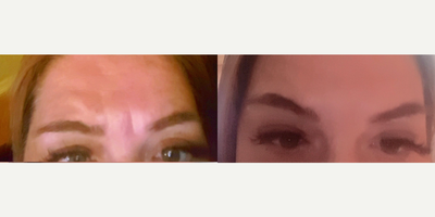 Botox before and after photo