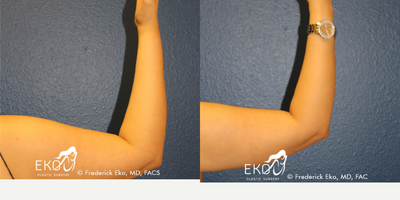 CoolSculpting before and after photo