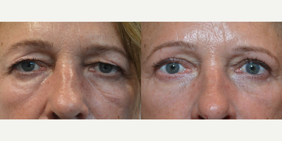 Eyelid Surgery before and after photo