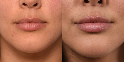 Lip Fillers before and after photo