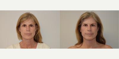 Neck Lift before and after photo