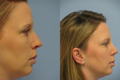 Rhinoplasty before and after photo
