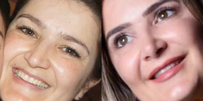 Rhinoplasty before and after photo