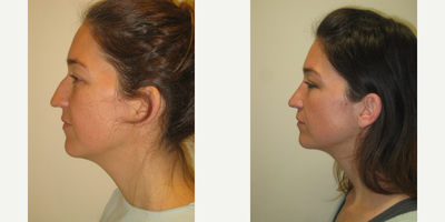 Rhinoplasty before and after photo