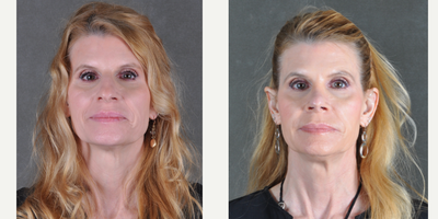 Rhinoplasty before and after photo