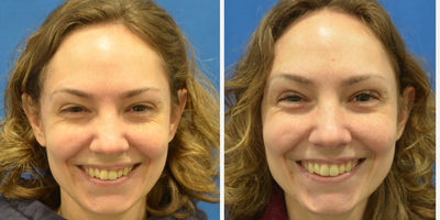 Skin Rejuvenation before and after photo