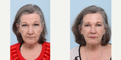 Voluma before and after photo