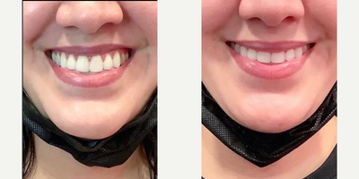 Botox for Gummy Smile before and after photo