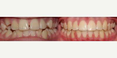 Braces before and after photo