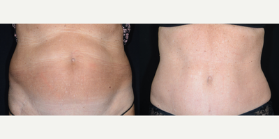 Tummy Tuck before and after photo