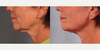 Ultherapy before and after photo